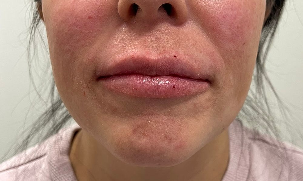 Lip Fillers Before & After
