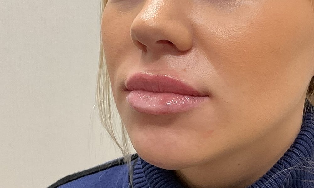 Lip Fillers Before & After