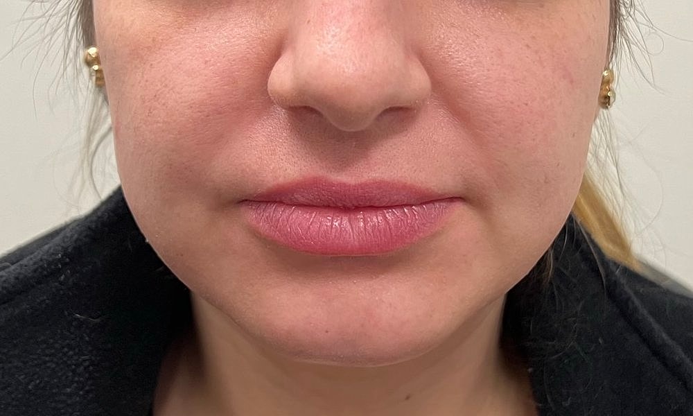 Lip Fillers Before & After