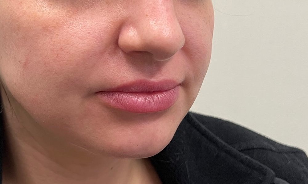 Lip Fillers Before & After