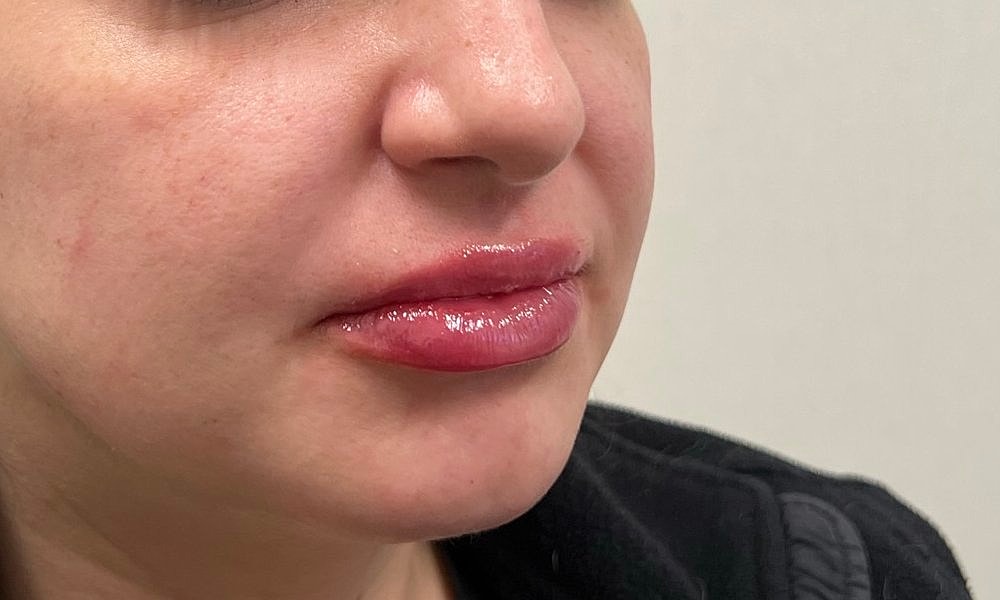 Lip Fillers Before & After