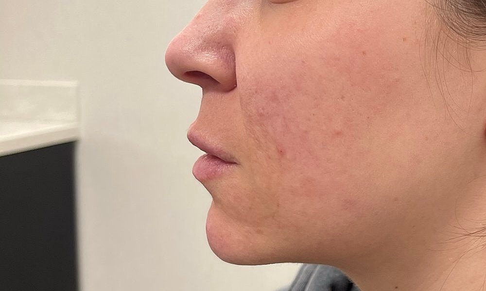 Lip Fillers Before & After