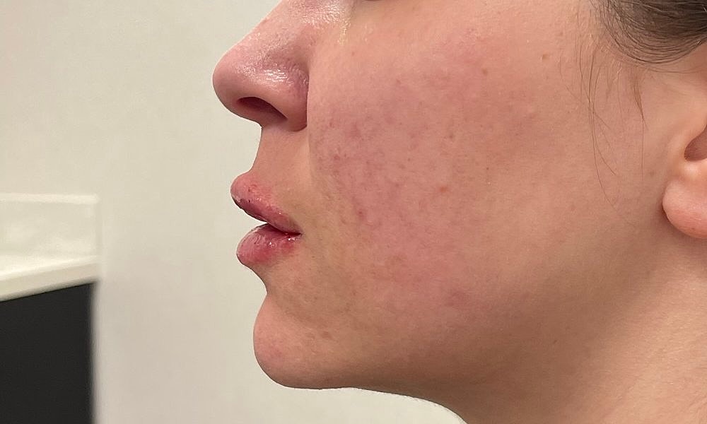 Lip Fillers Before & After