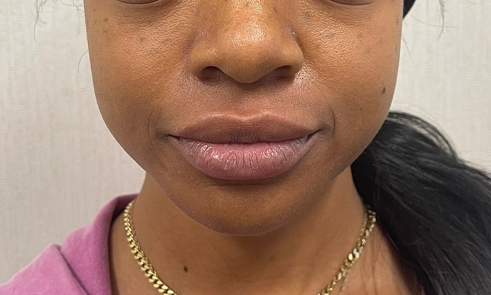 Lip Fillers Before & After