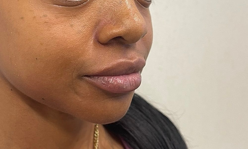 Lip Fillers Before & After