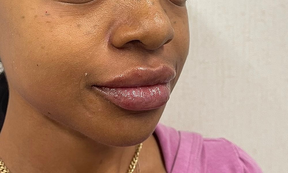 Lip Fillers Before & After