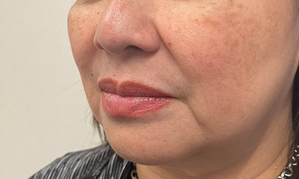 Lip Fillers Before & After