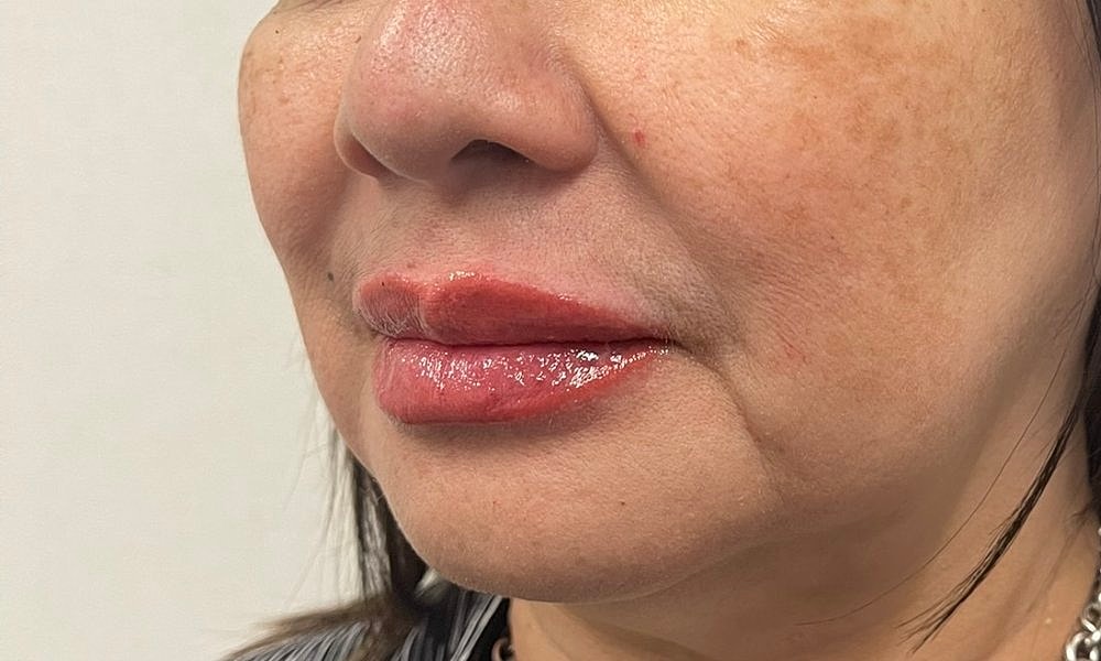 Lip Fillers Before & After