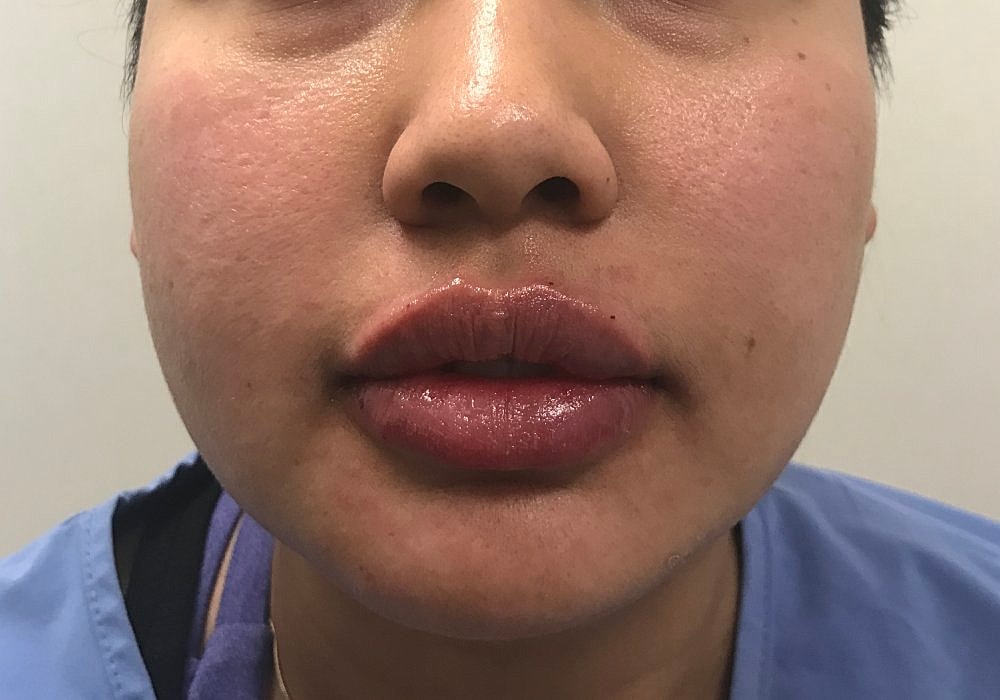 Lip Fillers Before & After