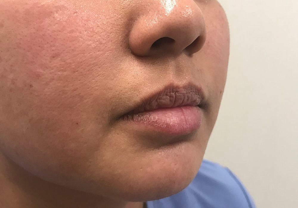 Lip Fillers Before & After