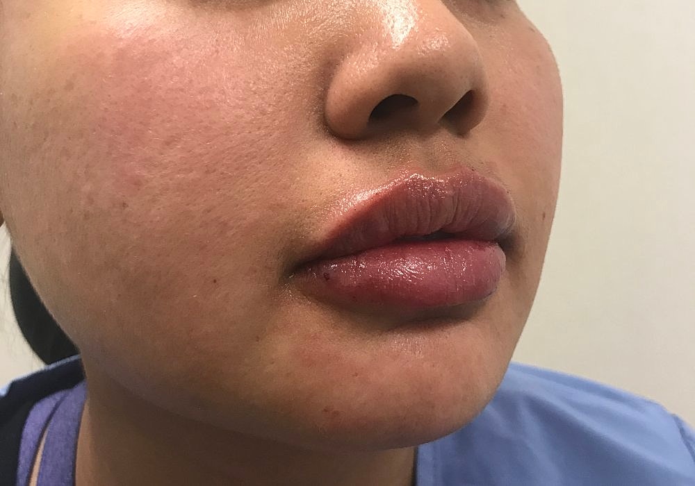 Lip Fillers Before & After