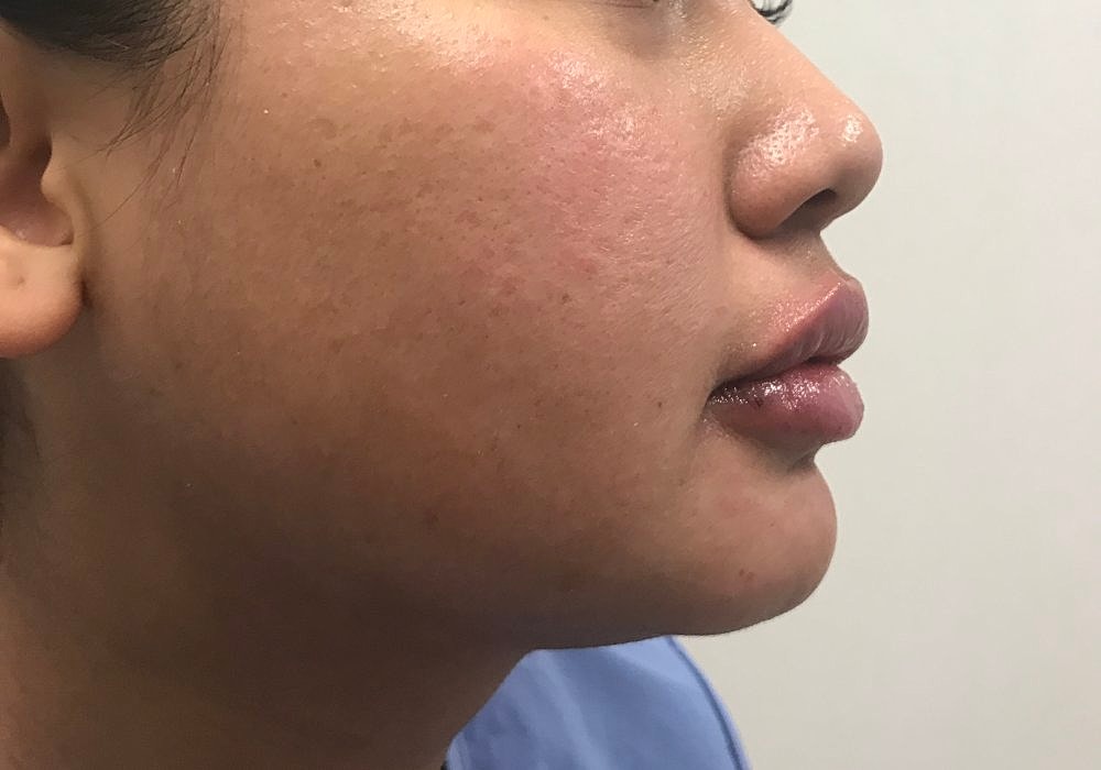 Lip Fillers Before & After