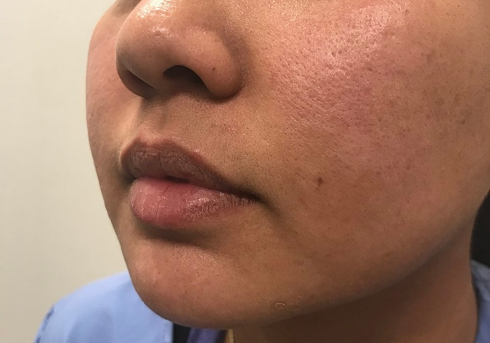 Lip Fillers Before & After