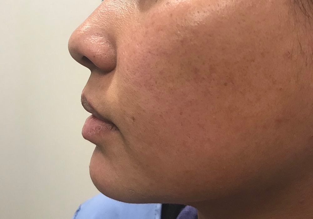 Lip Fillers Before & After