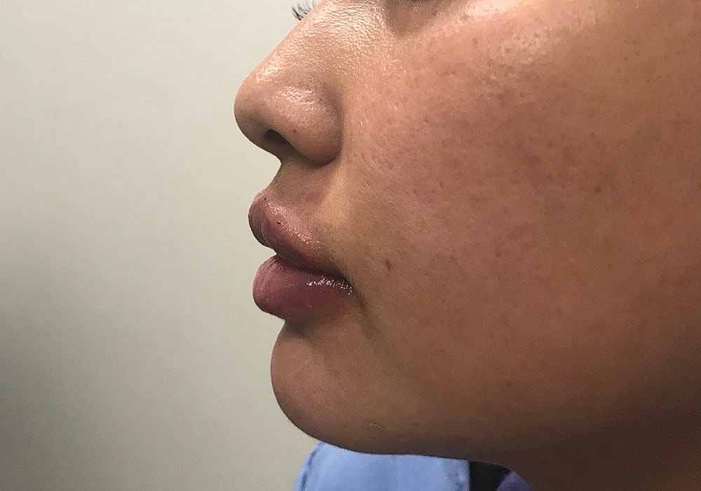 Lip Fillers Before & After