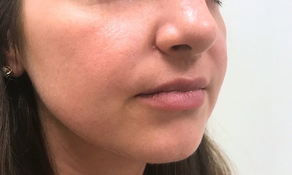 Lip Fillers Before & After