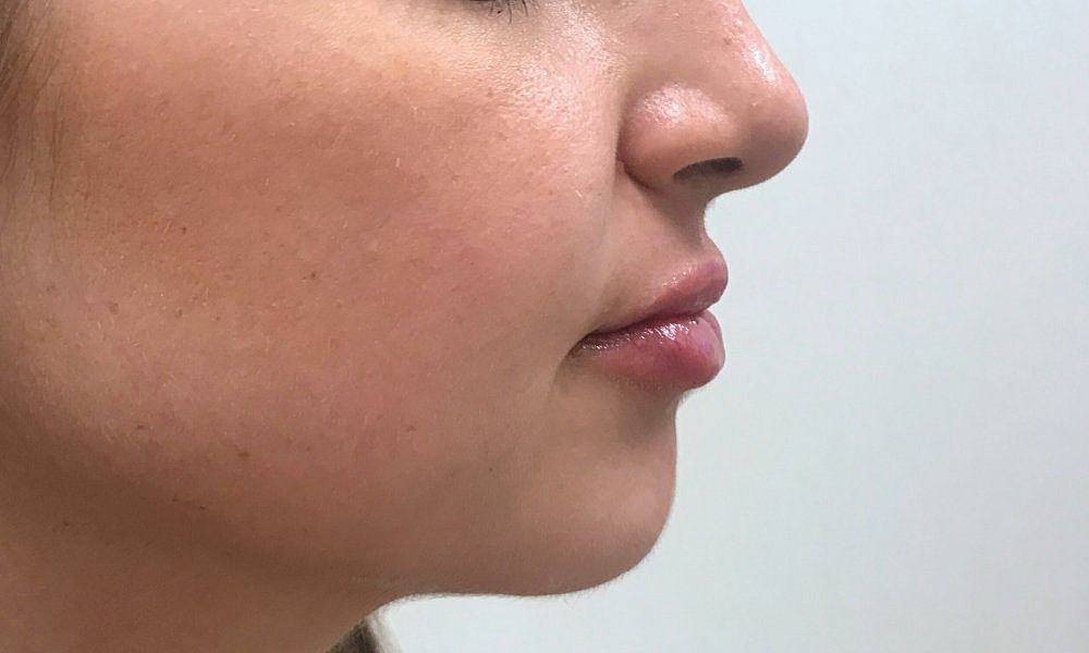 Lip Fillers Before & After