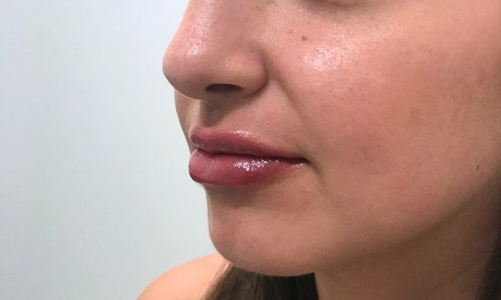 Lip Fillers Before & After