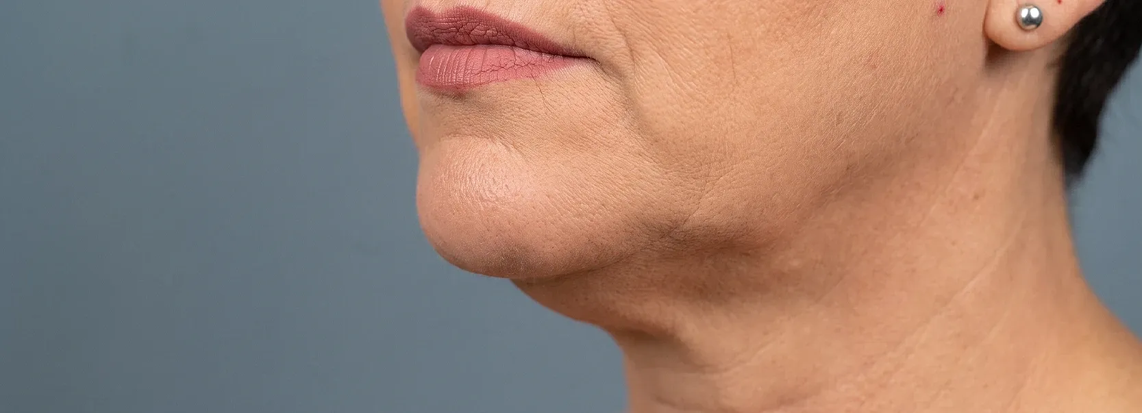 Chin and Neck Contouring in Houston
