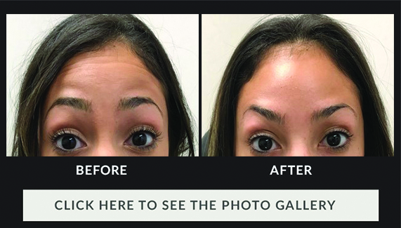 woman with darker skin tone's forehead before and after Botox, no lines after treatment
