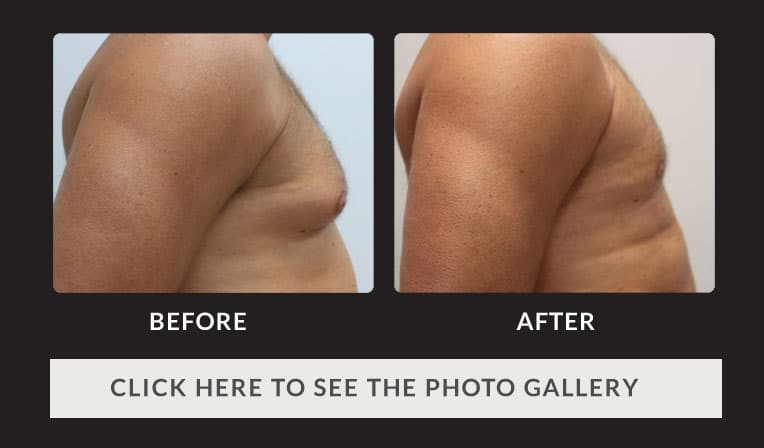 man's chest before and after male breast reduction
