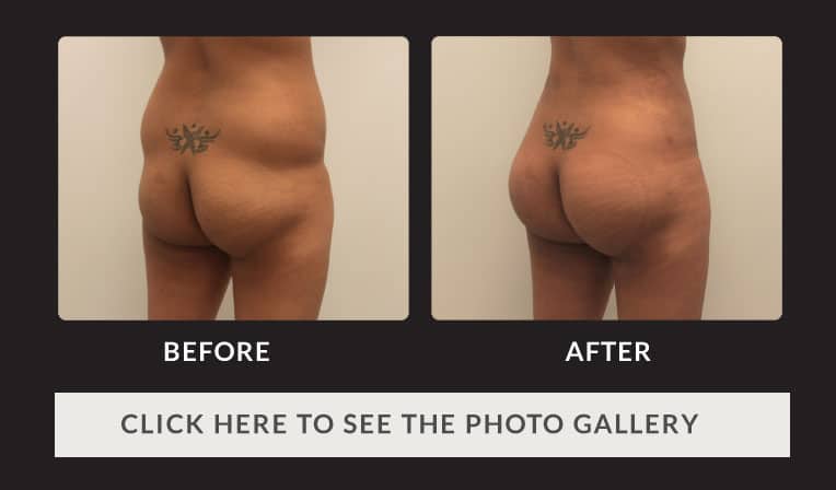 before and after of a naked woman's buttocks