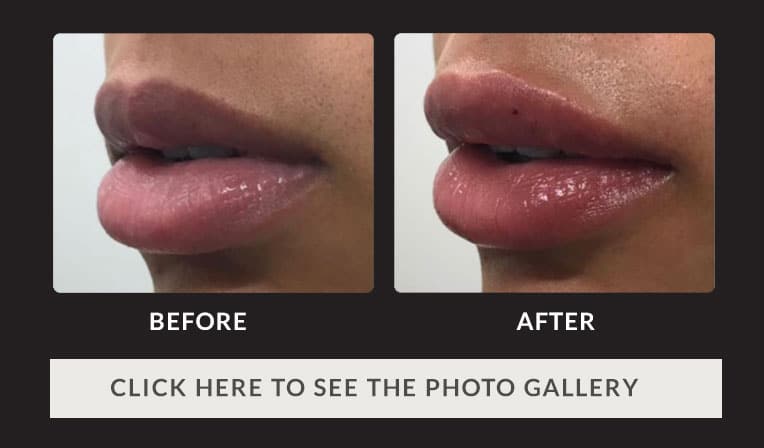 Lip Augmentation Before & After Results