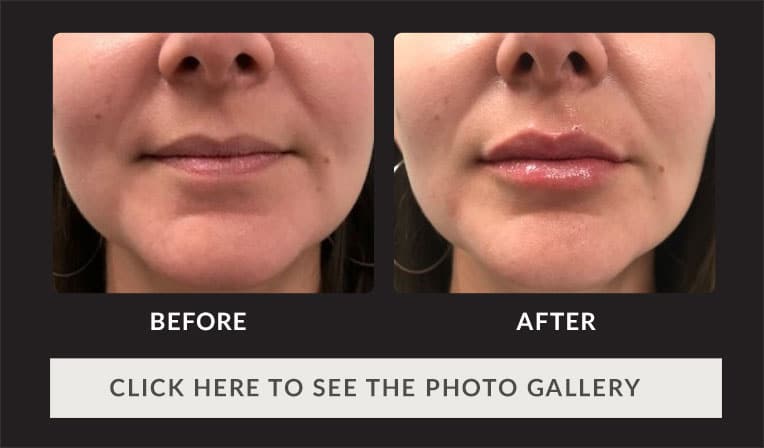 female patient's lips before and after dermal fillers, much fuller after injection