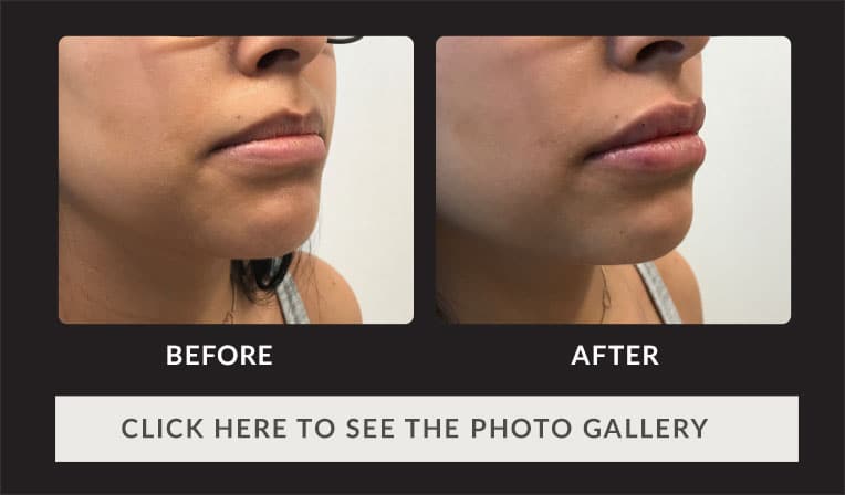 side view of female patient's lips before and after dermal fillers, much fuller after injection