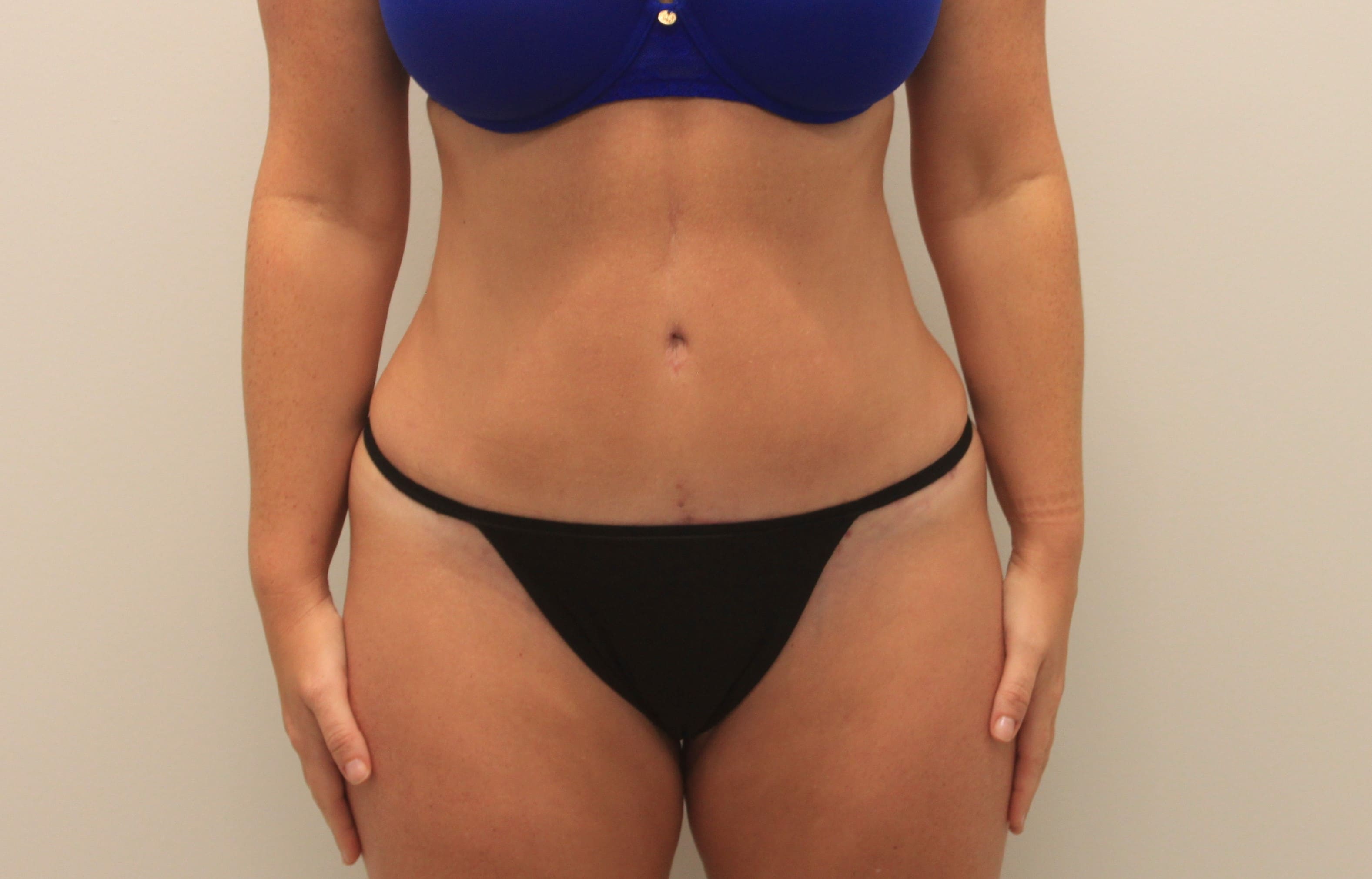 The Perfect Pairing: the SMART Tummy Tuck and 360-Degree Liposuction - Body  by Ravi
