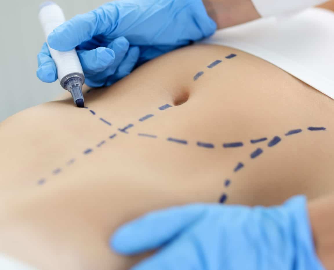 The Perfect Pairing: the SMART Tummy Tuck and 360-Degree Liposuction