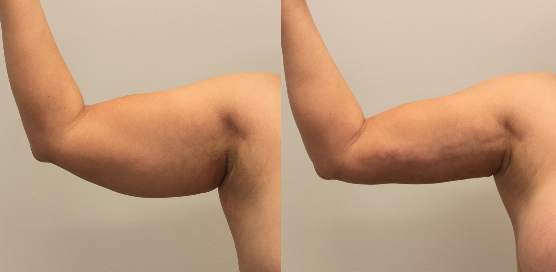 patient's arm before and and after bodytite skin tightening, less fat after procedure