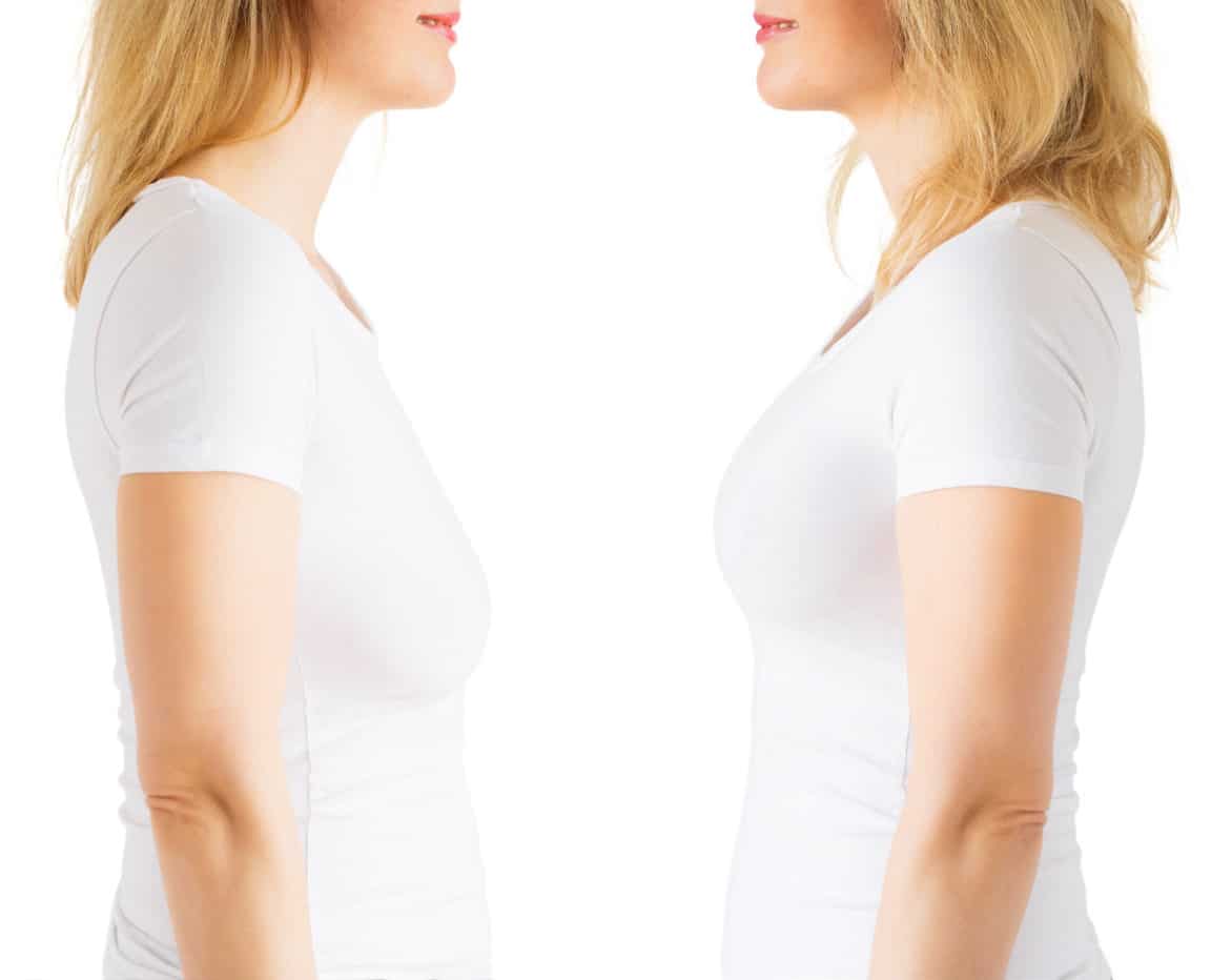 Natural Looking Breast Augmentation with Fat Transfer