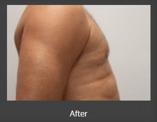 side view of man's chest after vaser liposuction, flatter after procedure