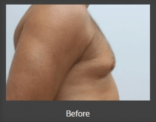side view of man's chest before vaser liposuction