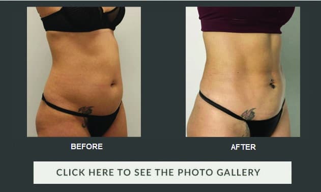 Vaser lipo before and after - female tummy