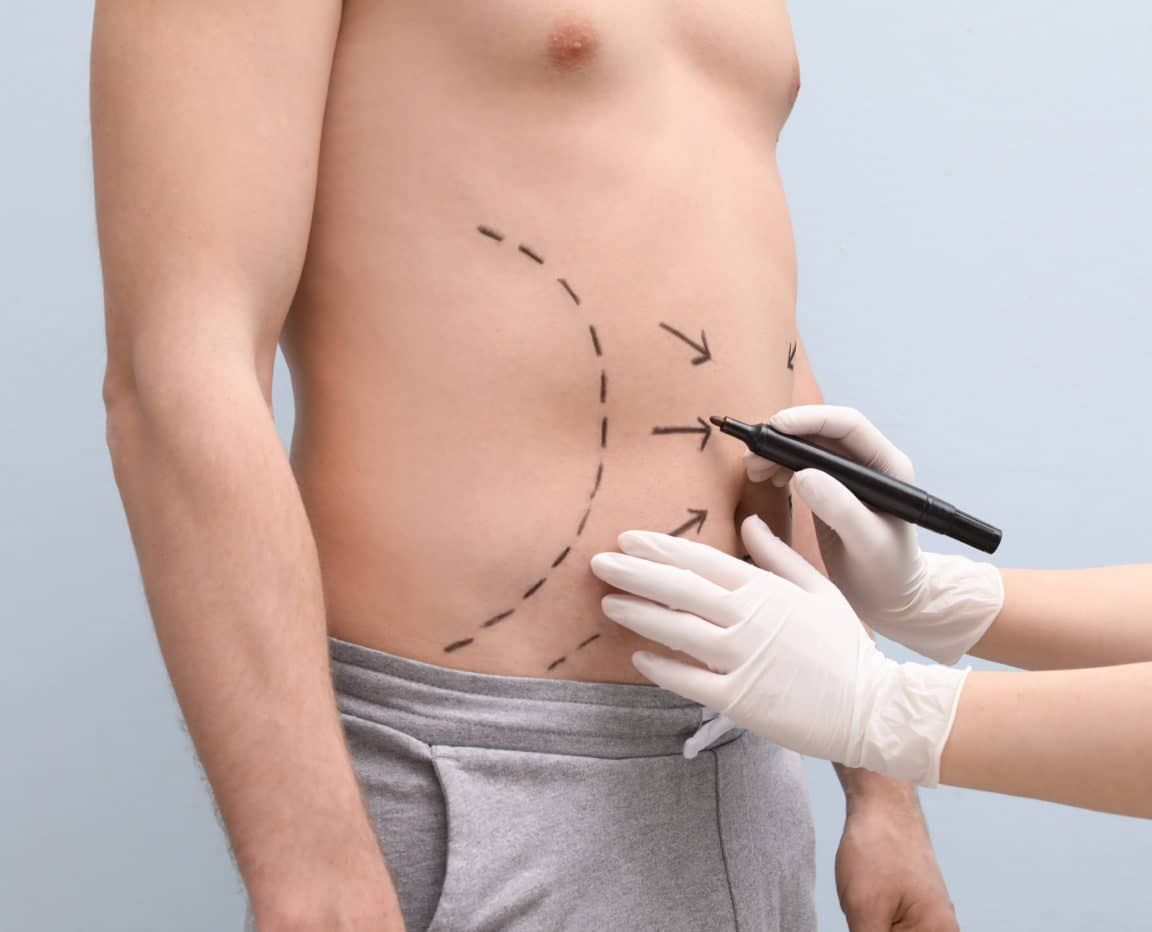 Why Dr. Ravi’s Smart Tummy Tuck Includes VASER Liposuction