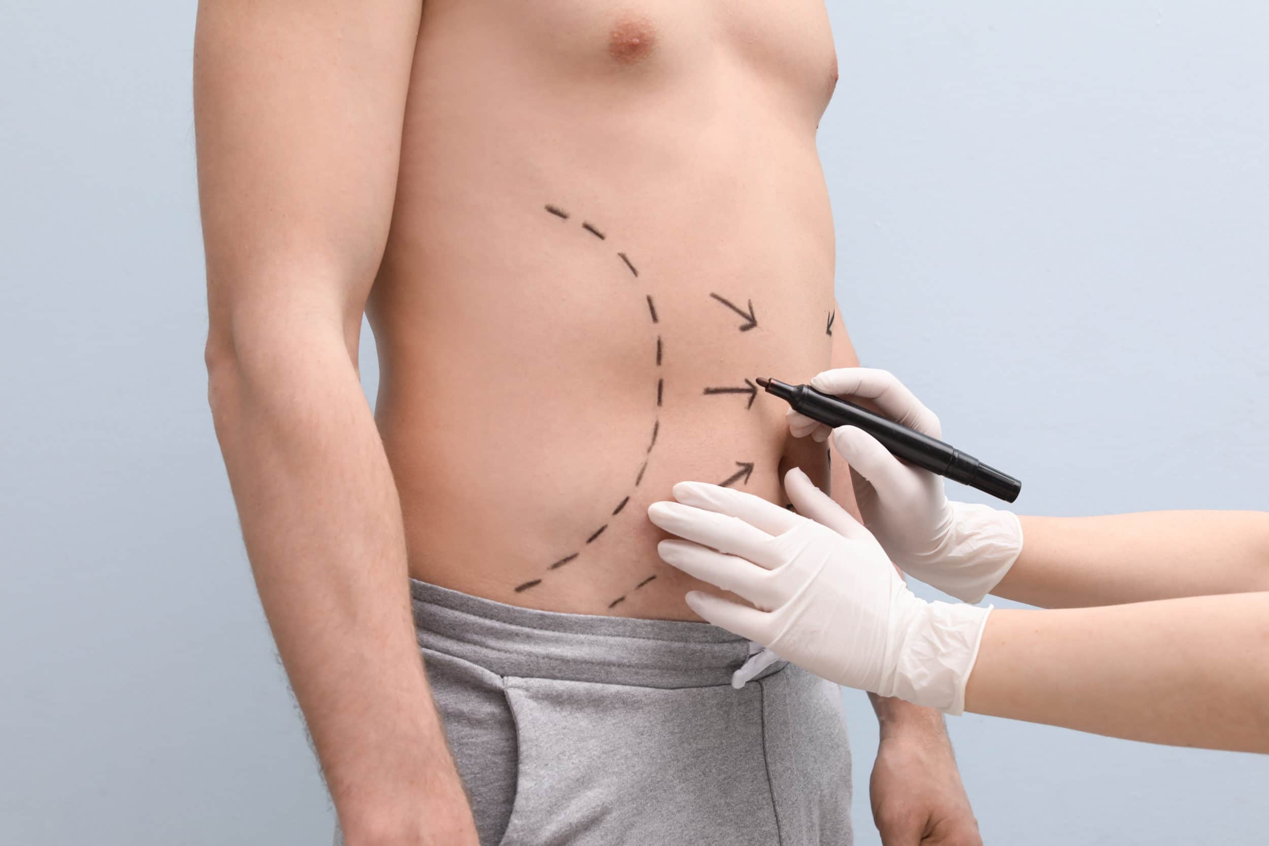 Why Dr. Ravi's Smart Tummy Tuck Includes VASER Liposuction