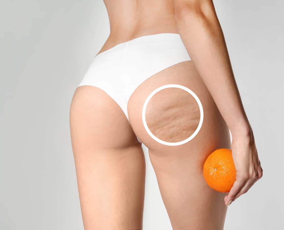 Young woman with orange on light background. Problem of cellulite