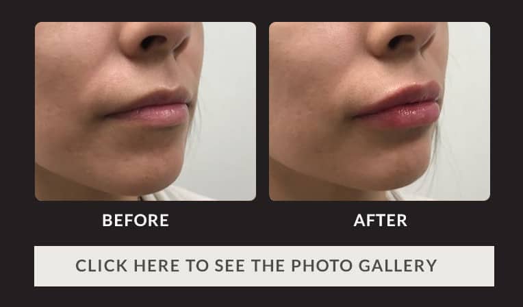 woman's lips before and after fillers, fuller and more plump after treatment