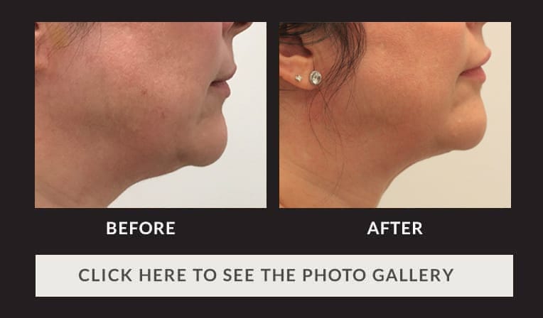 side view of lower half of woman's face before and after facetite procedure, chin more pronounced after procedure