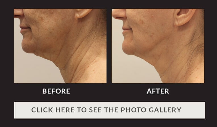 side view of lower half of patient's face and neck, fewer wrinkles and more pronounced chin after facetite procedure