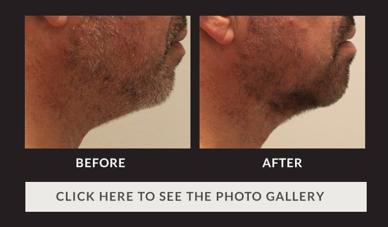 side view of lower half of man's face before and after facetite, chin more pronounced after procedure