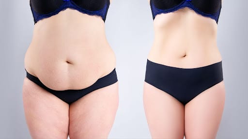 What Patients Need To Know About Life After a Tummy Tuck