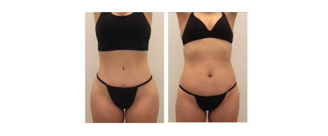 Why Choose Dr. Ravi For a SMART Tummy Tuck?, Plastic Surgeon Houston -  Cosmetic Surgery Katy